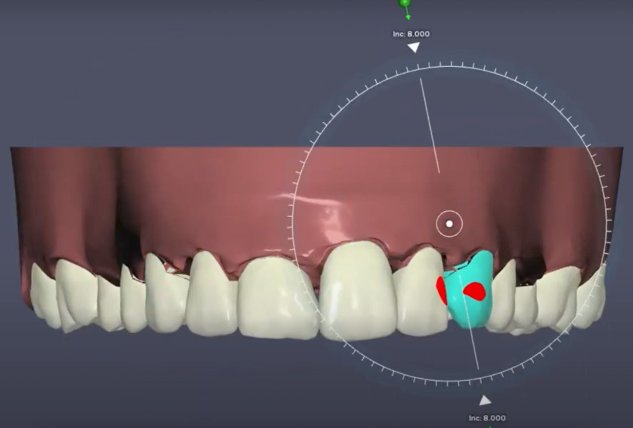 3D digital clear aligner treatment plan, front view of teeth setup